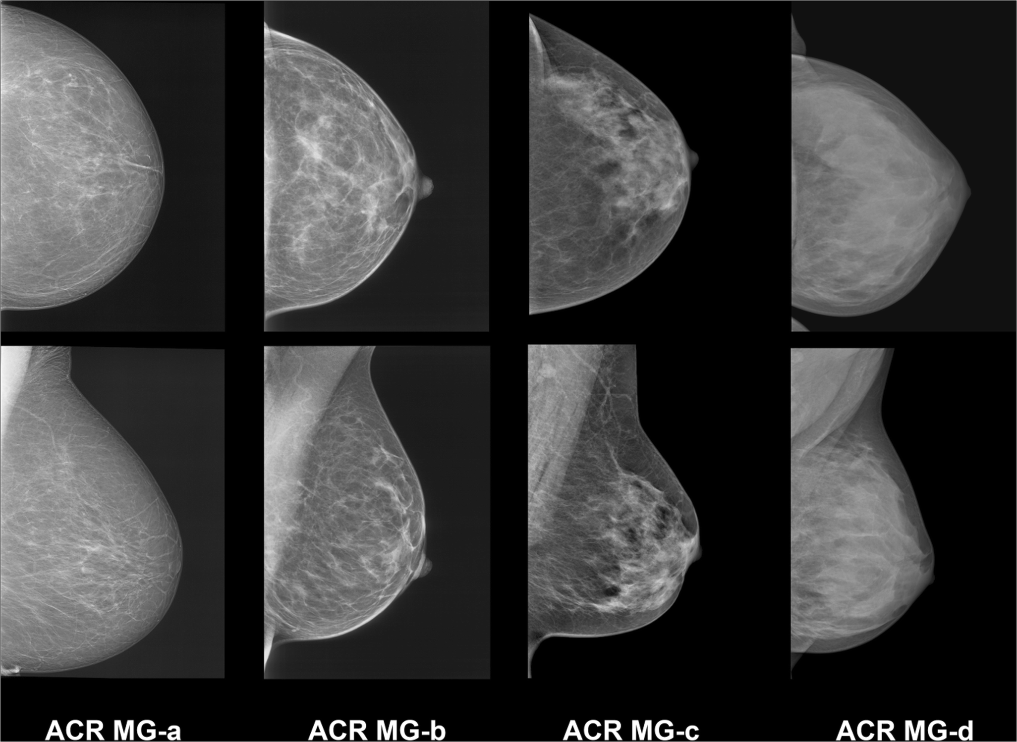 Found a breast change? How mammography, ultrasound and MRI can help 